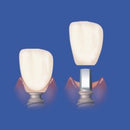 Implant Cement Standard Pack 5ml. Automix Syringe and Tips - Premier - BriteSources