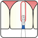 Cylindrical 0.8 mm Dia. Medium Grit Diamond Bur 5 per pack. 107.8M2 - Osung USA