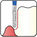 Cylindrical, Hemispherical End 1.6 mm Dia. Medium Grit Diamond Bur 5 per pack. 137.16M1 - Osung USA