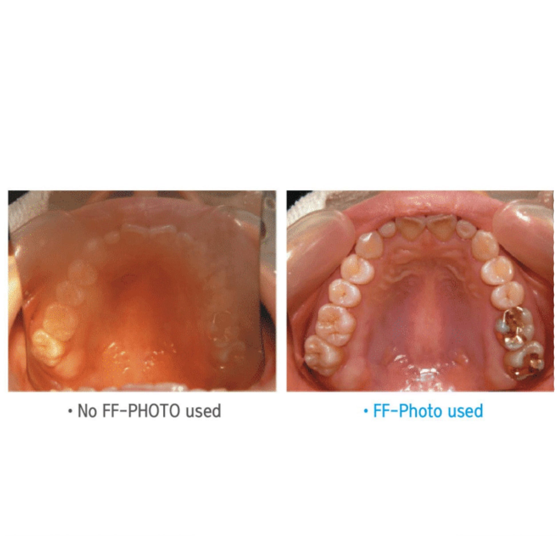 Occlusal Medium Mirror for Fog Free Intra Oral Photo System -DMBF3 - Osung USA