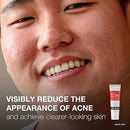 J&J Neutrogena Skin Care Gel Acne Spot .5Oz 6/Bx 4Bx/Cs -02480 - BriteSources