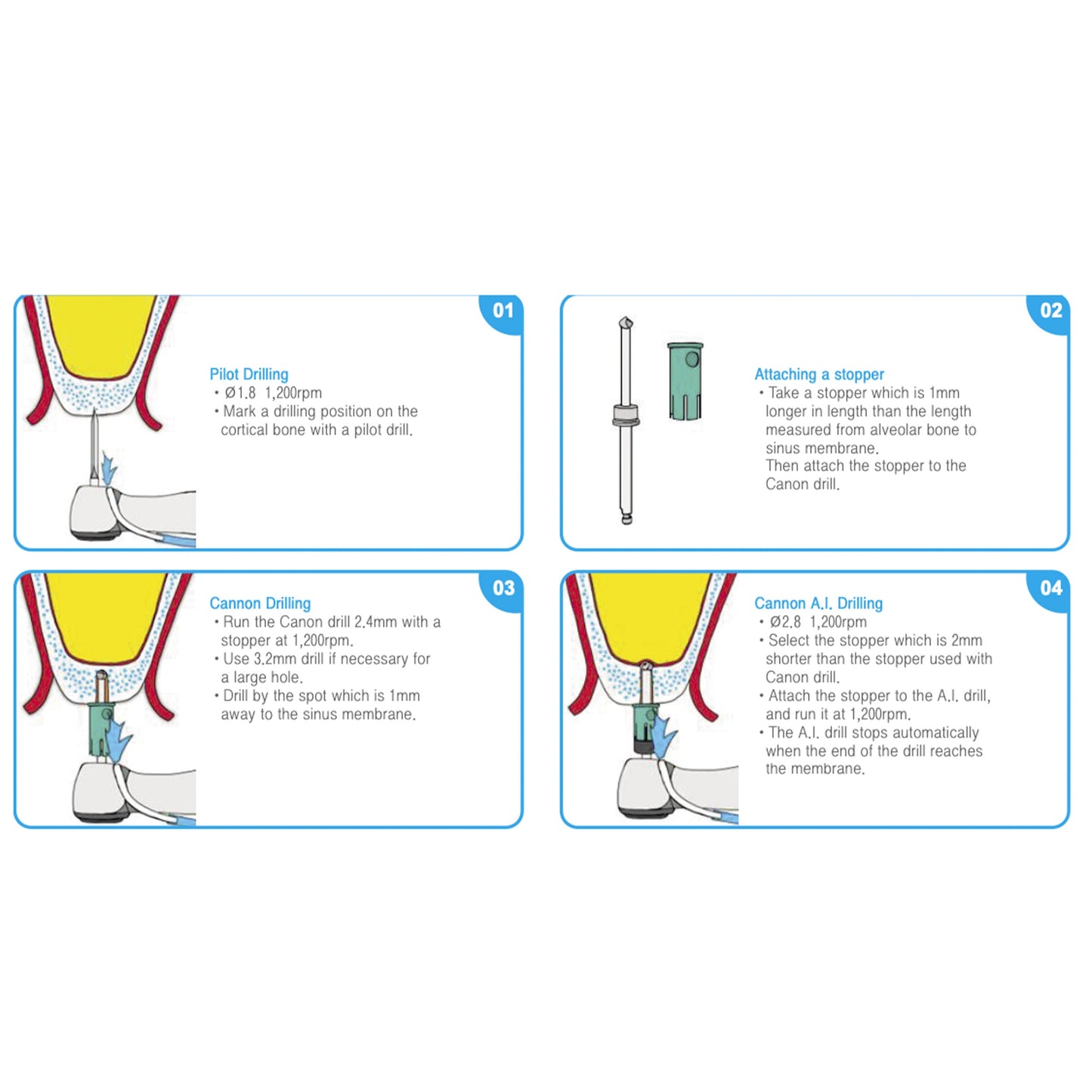 Osung Sinus Lift Crestal Approach Kit with Aqua Lift OCA-KIT - Osung USA