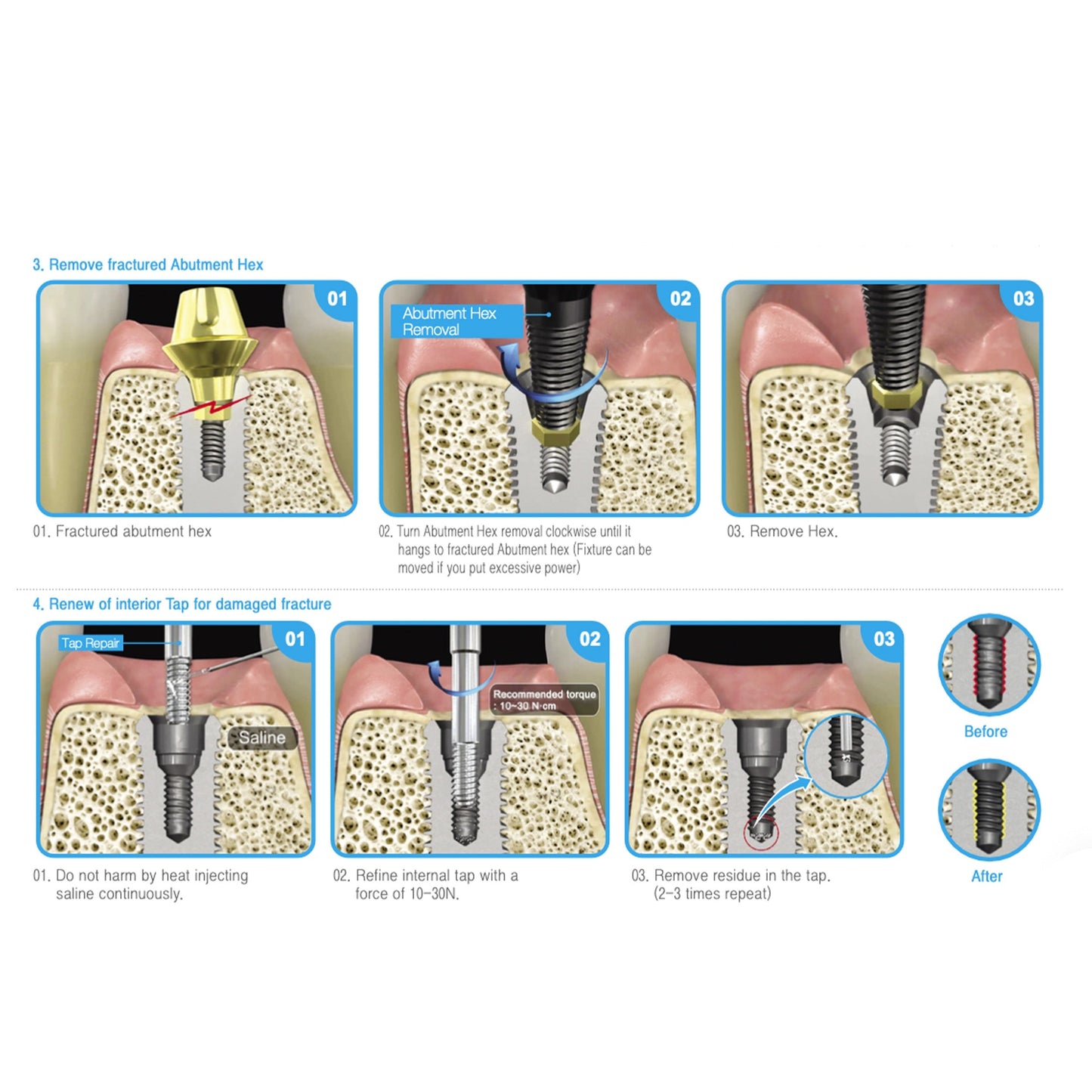 Osung Dental Screw Removal Kit -OSR-KIT - Osung USA