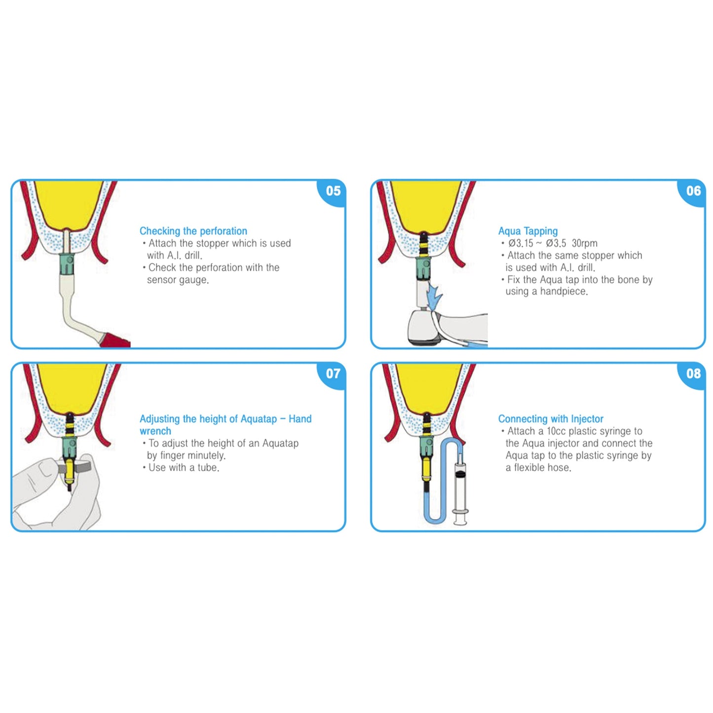 Osung Sinus Lift Crestal Approach Kit with Aqua Lift OCA-KIT - Osung USA