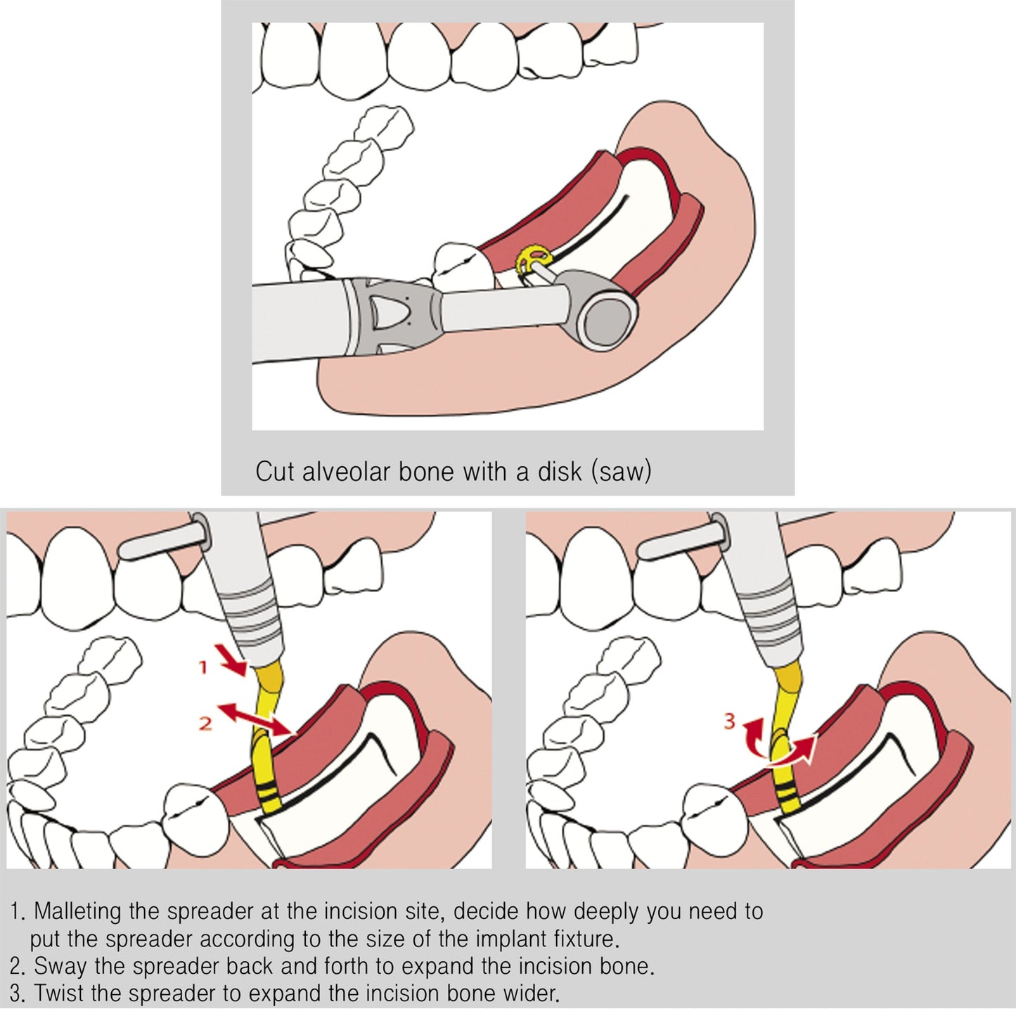 Osung 3.5mm Bone Spreader Osteotome Premium -BOC35R - Osung USA