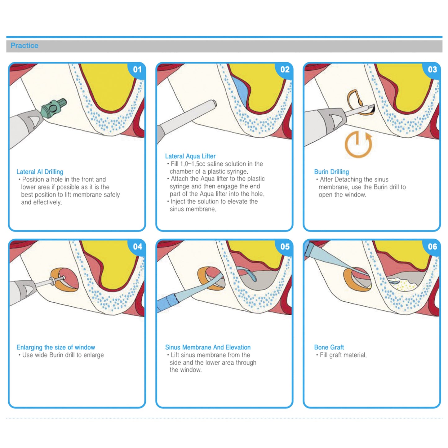 Sinus Lift Lateral Approach Kit Osung -OLA-KIT - Osung USA