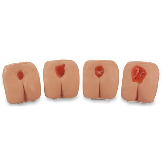 Bedsore Models, Life/Form Pressure Ulcer White, 1/Ea