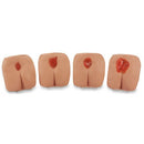 BEDSORE MODELS, LIFE/FORM PRESSURE ULCER WHITE, 1/EA