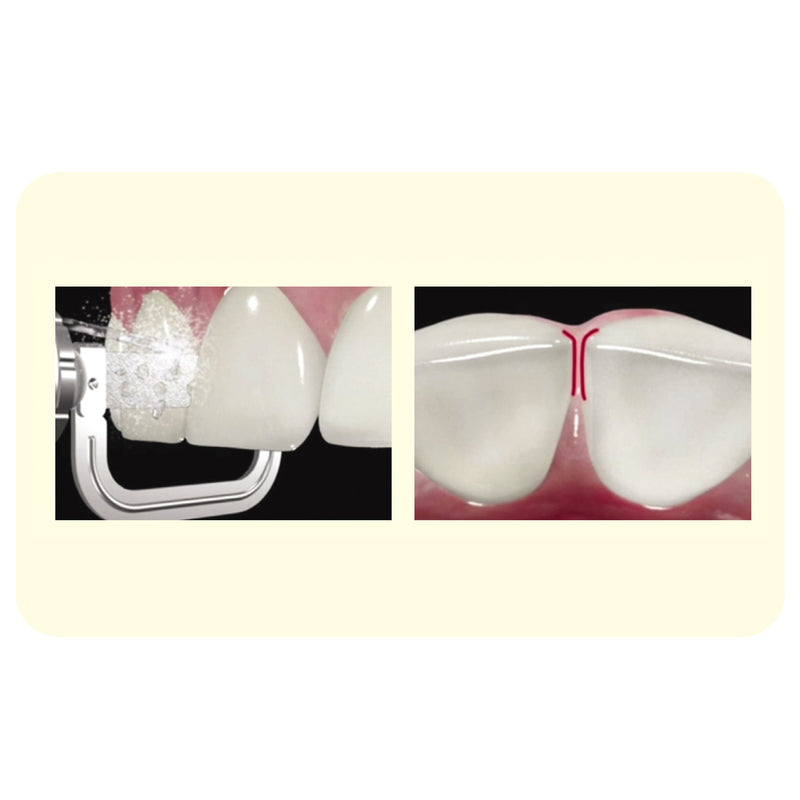 Osung Serrated Edge Interproximal Enamel reduction (IPR) Diamond Strip Orthodontic Strips - Osung USA