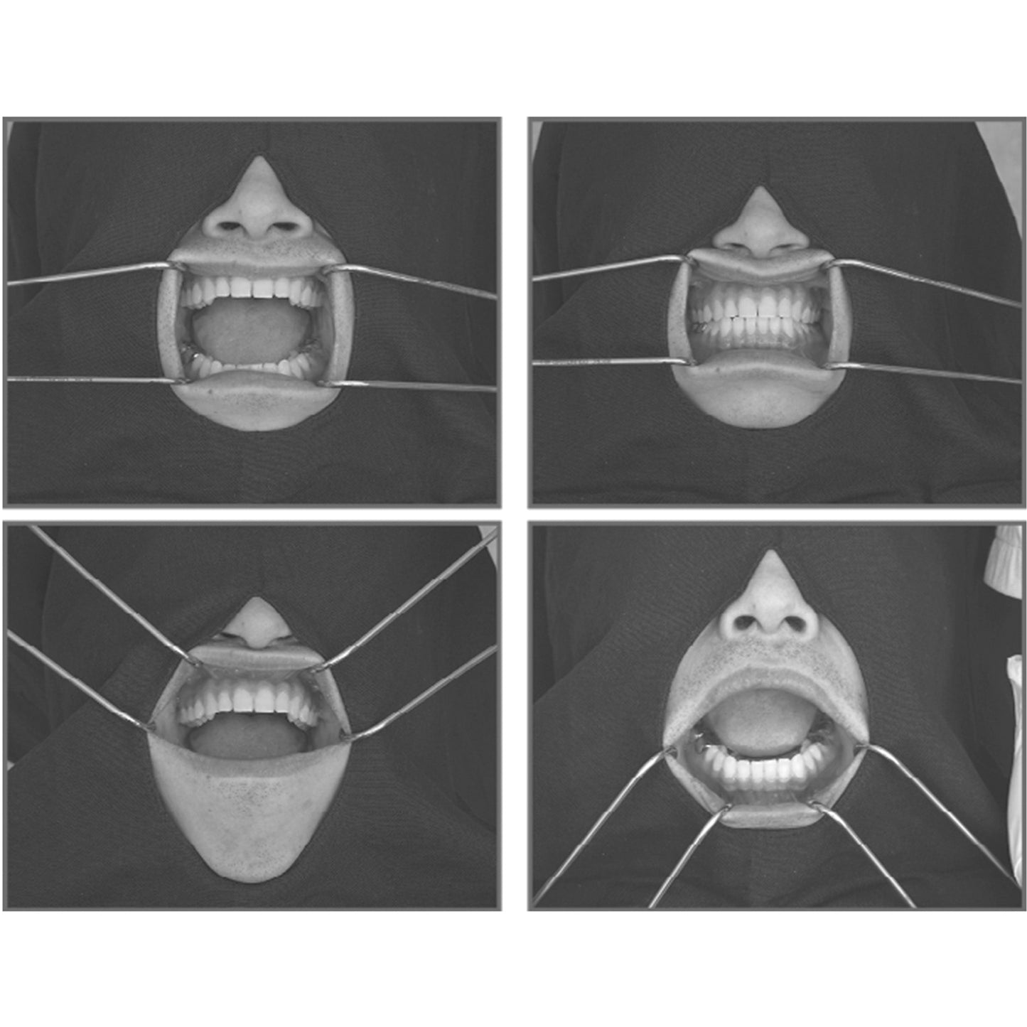 Osung Dental Columbia Cheek Retractor -RTCRC - Osung USA