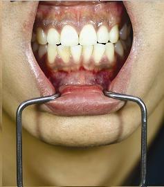Dental Orringer Lip Wider, Small / Child Size - BriteSources