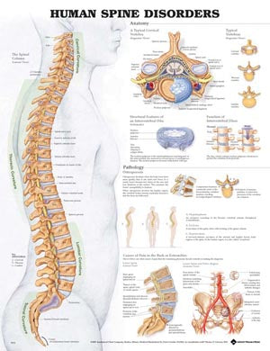 Anatomical Charts & Posters. Human Spine Disorders, 20" X 26", Styrene Plastic (026588) (Drop Ship Only). Poster The Human Spinestyrene (Drop), Each