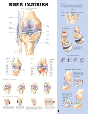 Anatomical Charts & Posters. Knee Injuries Chart, Styrene Plastic (026593) (Drop Ship Only). Poster Knee Injuries Styrene(Drop), Each